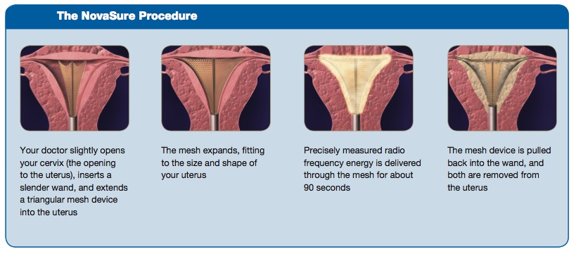 Ablation Novasure OBGYN Associates of Central FL