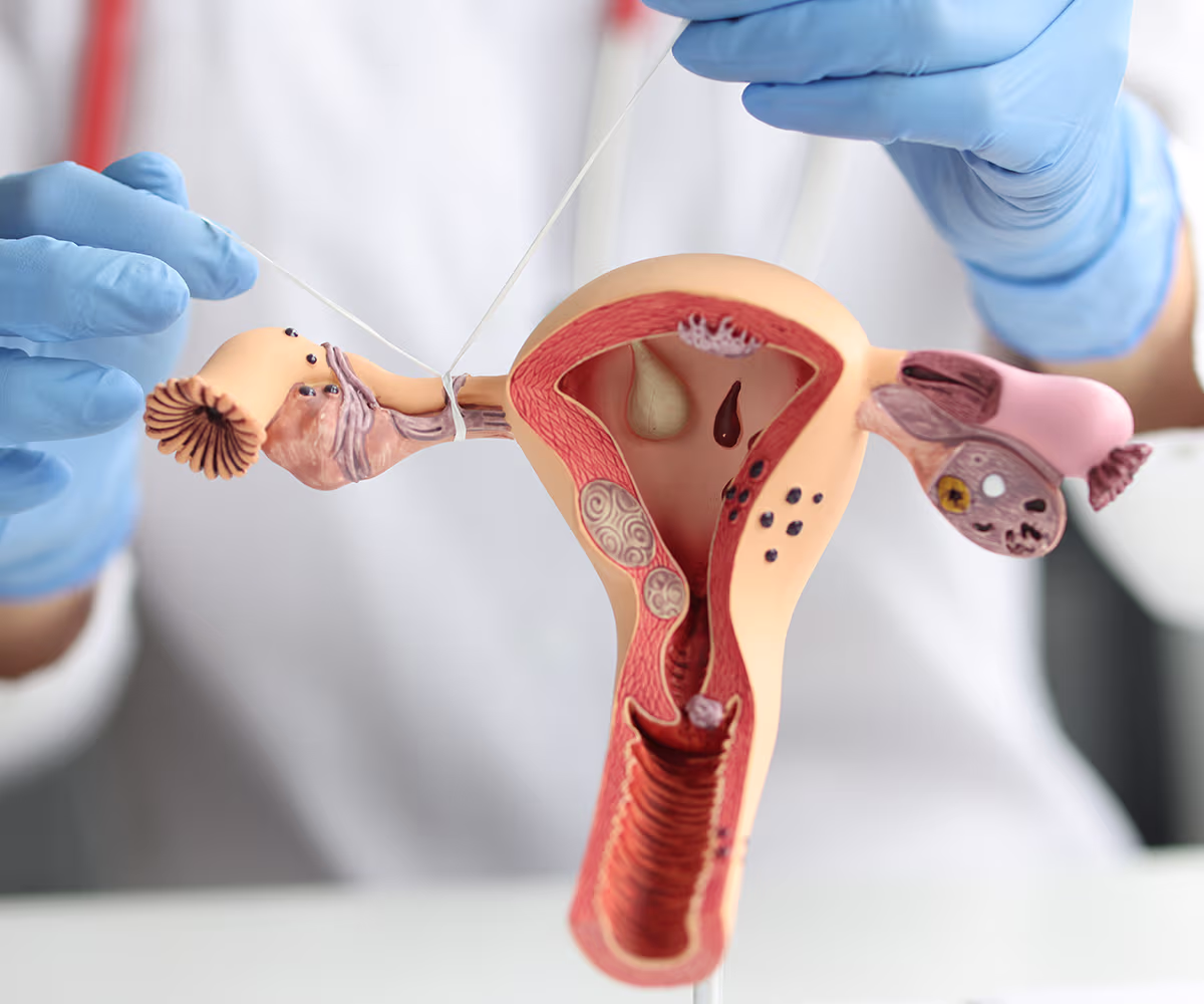 Bilateral Tubal Ligation Accent Image showing a doctor tying a fallopian tube on a model
