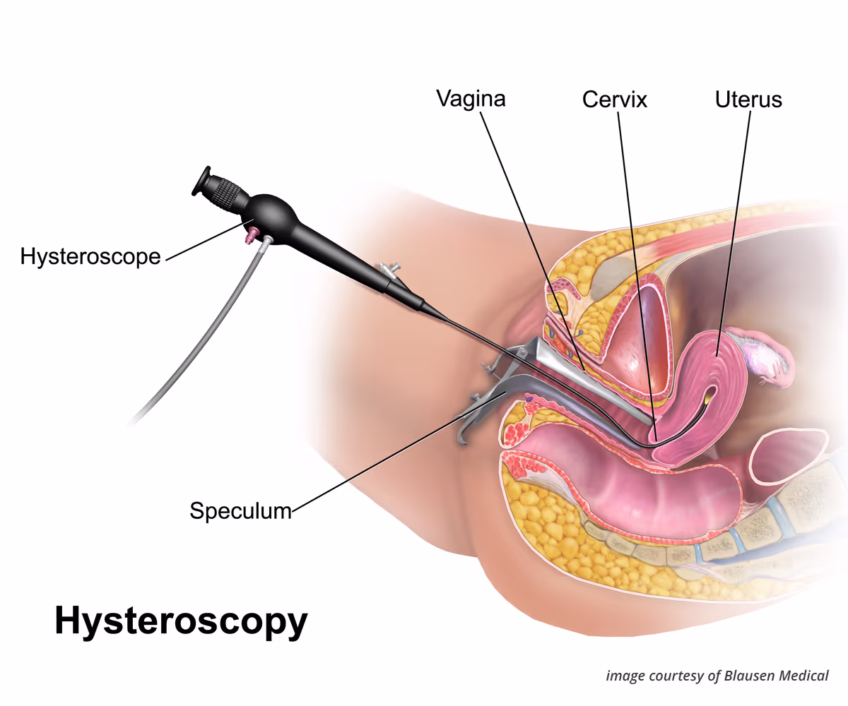 Hysteroscopy Accent illustration showing a hysteroscope inserted into a uterus