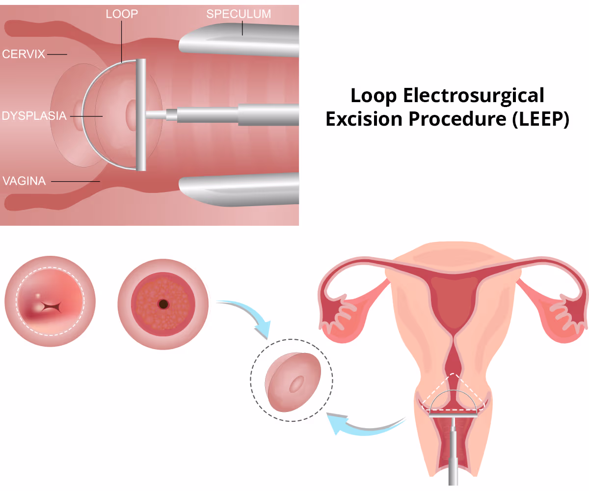 Loop Electrosurgical Excision Procedure (LEEP) Illustration