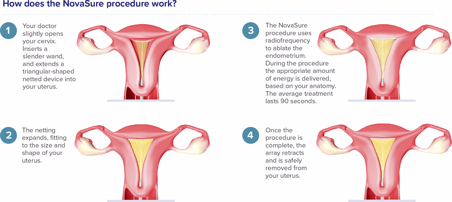 NovaSure Process Illustration